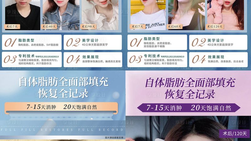 自体软骨隆鼻：揭秘费用构成与选择要点