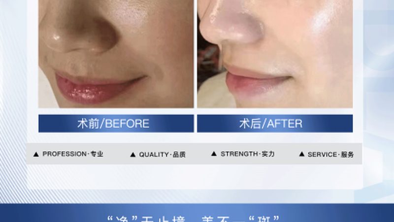 超声炮怎么选正规机构