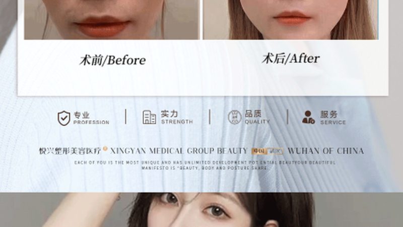 肉毒素注射后洗脸禁忌揭秘