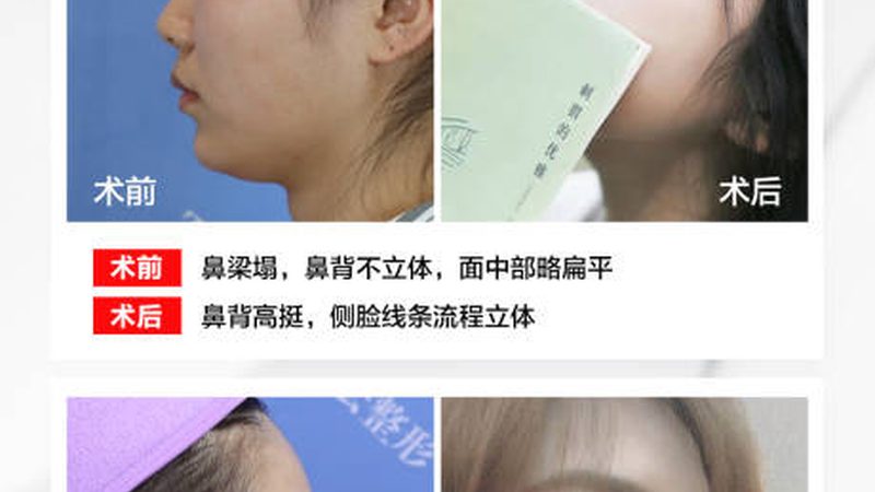 埋线提升PDO线价格乱象背后：厂家直销的真实逻辑