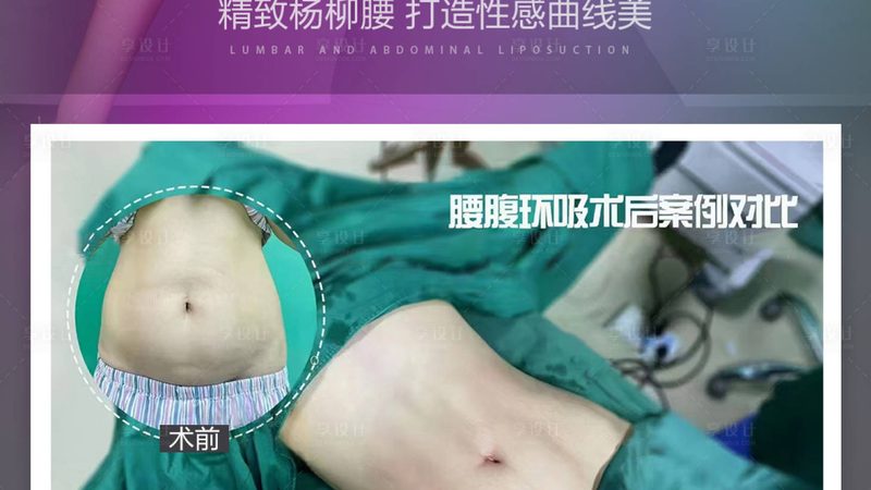 成都激光脱毛前需要做什么准备