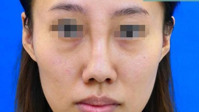 医美局麻的优缺点